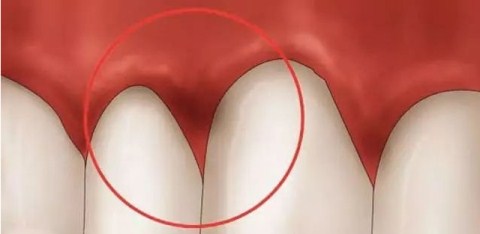 牙龈肿痛怎么治疗最好,治疗牙龈肿痛的中药方