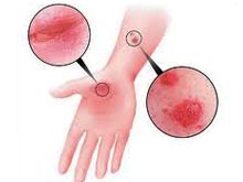 湿疹痒得要命,湿疹浑身痒得睡不着觉怎么办