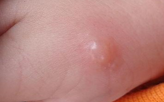 如何预防手足口病小常识,手足口病症状和预防方法