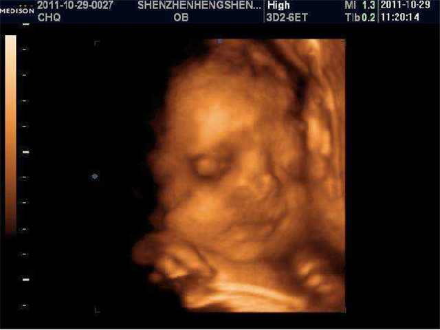四维彩超能看出来胎儿畸形吗,四维彩超可以看出胎儿畸形吗