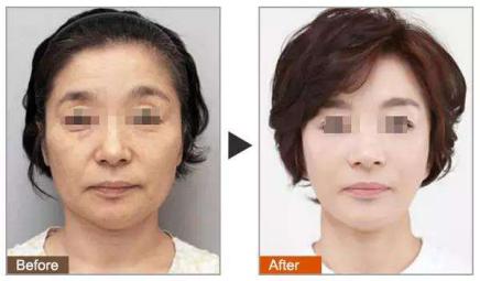 为什么做完蛋白矫正发尾会翘,为什么做完蛋白矫正会头痒