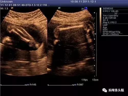 医院的b超检查设备都一样吗,医院的b超是什么