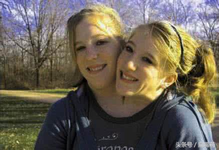 连体婴儿真实存在吗,连体婴到底算一个人还是两个人