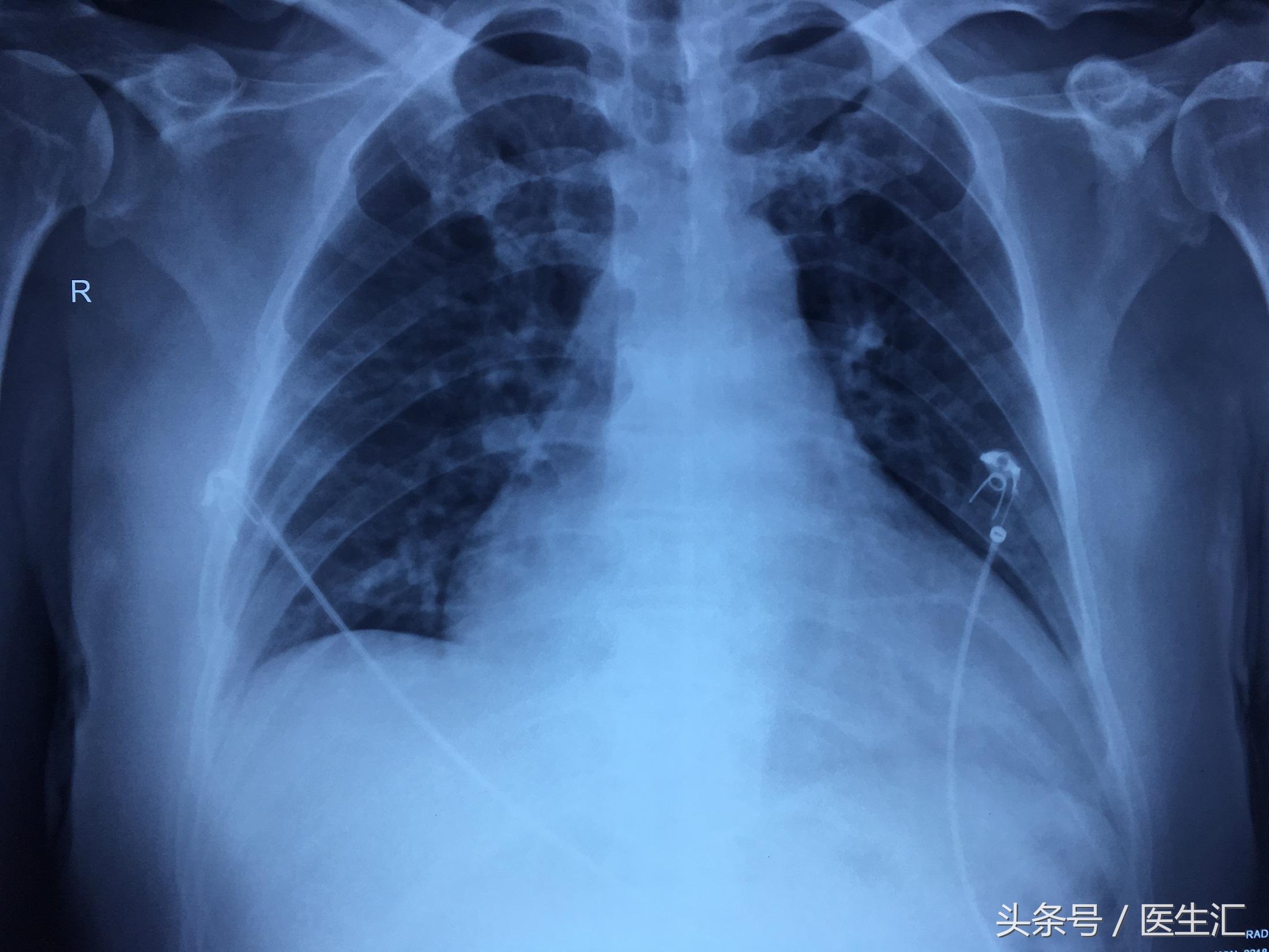 喝白酒后呼吸困难怎么回事,喝啤酒呼吸困难怎么回事