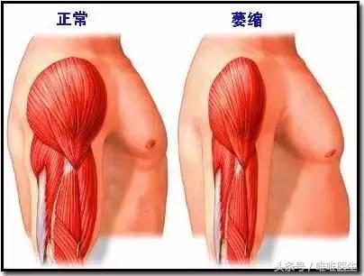 颈椎疼肩周炎腰痛一个动作全解决,肩周炎正确锻炼方法5个动作视频