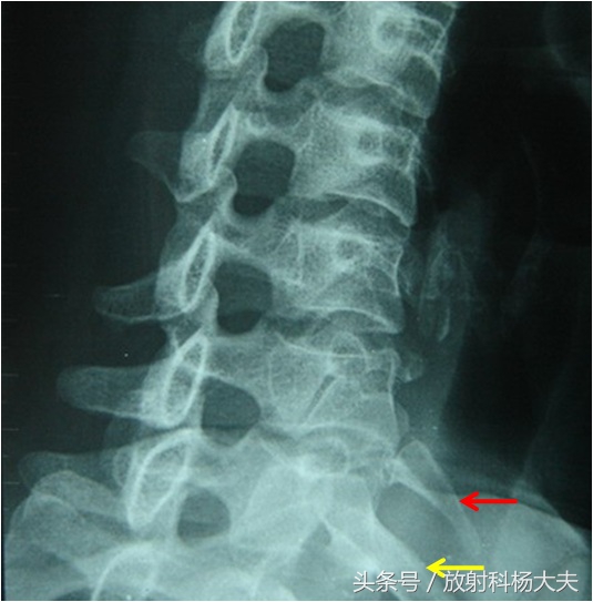 脖子比普通人长一倍,脖子好像比别人长一点