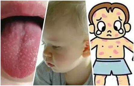 出疹时间顺序口诀,猩红热出疹顺序口诀