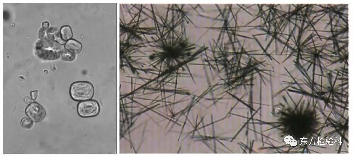孕妇尿结晶数值多少是结石,尿结晶数量高看什么科