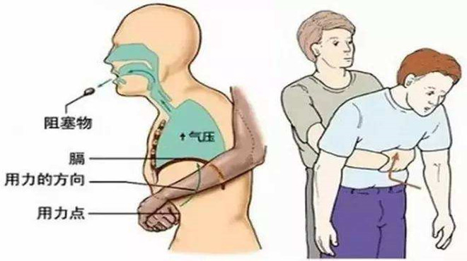 婴儿被异物卡住喉咙急救,小孩喉咙卡异物急救视频