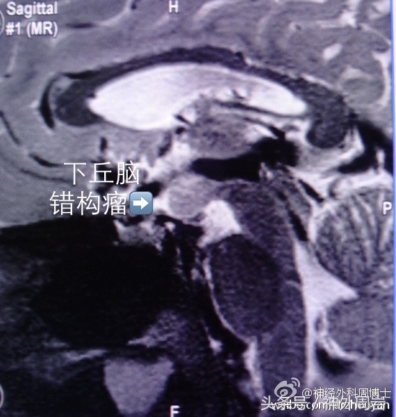 痴笑癫痫发作时会怎样,痴笑性型癫痫病发作是什么感觉