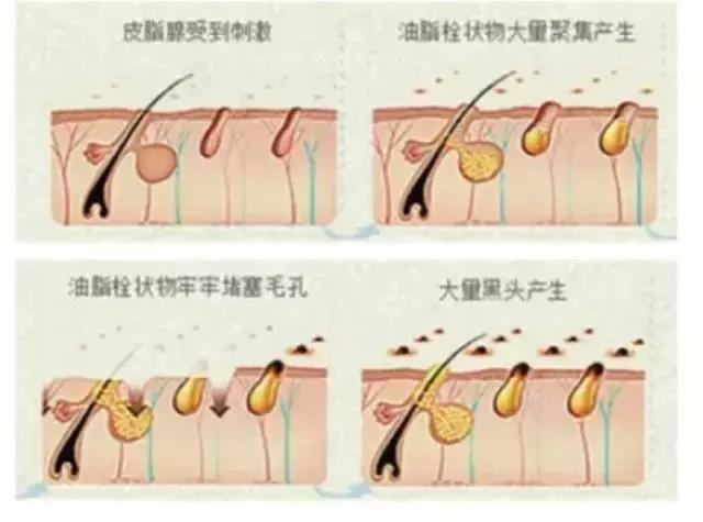 如何不挤就可以去黑头,黑头别再用手挤三个去黑头小妙招