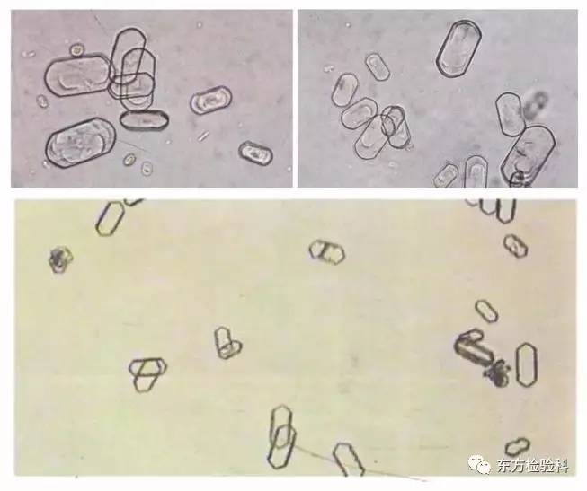 孕妇尿结晶数值多少是结石,尿结晶数量高看什么科