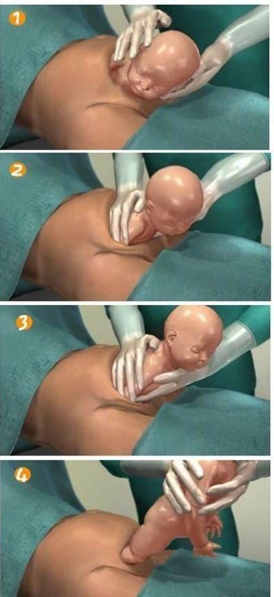 剖腹产的全流程真实记录,顺产剖腹产的十个真相