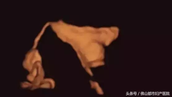 四维超声输卵管造影亲身经历,无痛四维输卵管造影