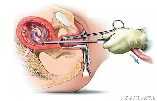 你以为上了环就能一劳永逸？更多的麻烦在等着你呢！