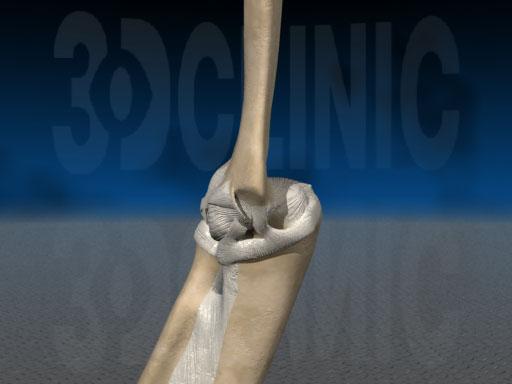 4岁左桡骨小头骨皮质断裂,小孩桡骨小头发育缺失