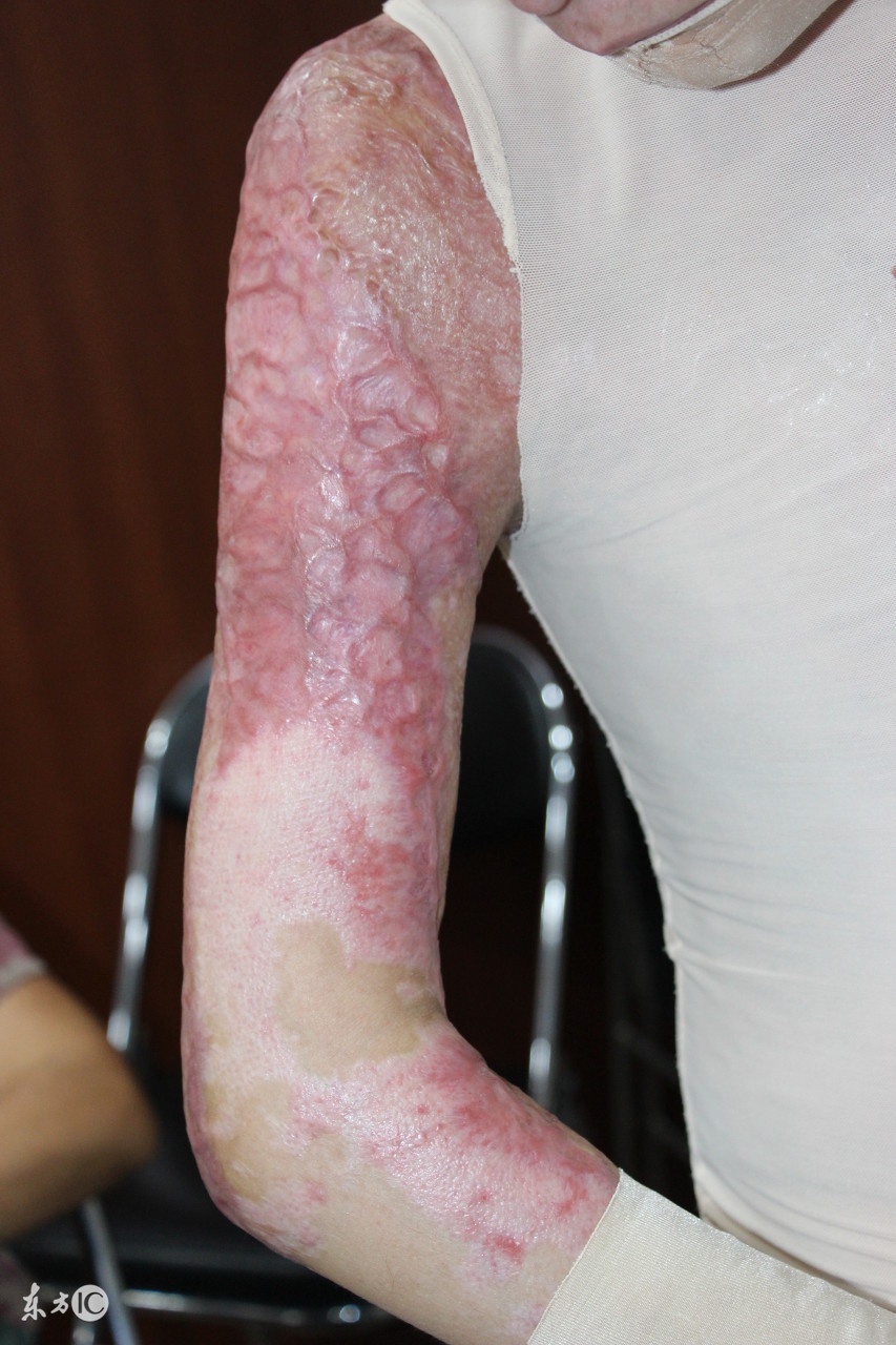 电烧伤创面应怎样处理,外伤创面处理原则