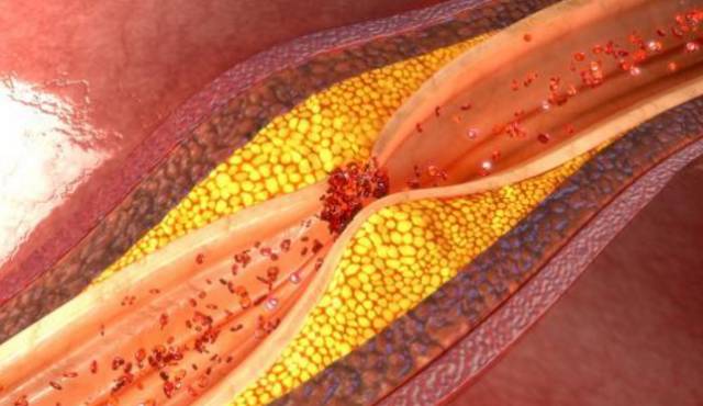 清除血管壁脂类吃什么,血管油脂堵塞怎么快速清理