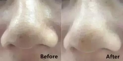 控油祛痘祛黑头粉刺闭口面膜推荐,哪种清洁面膜祛黑头粉刺有效果