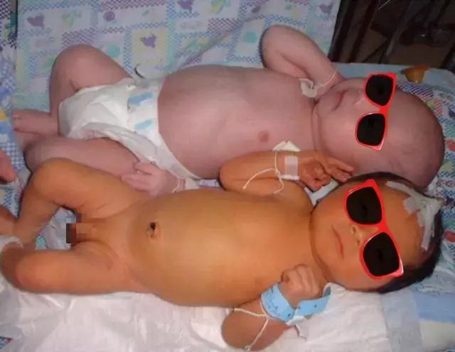 新生儿黄疸照蓝光深圳哪家医院好,黄疸日间光疗一天多少钱