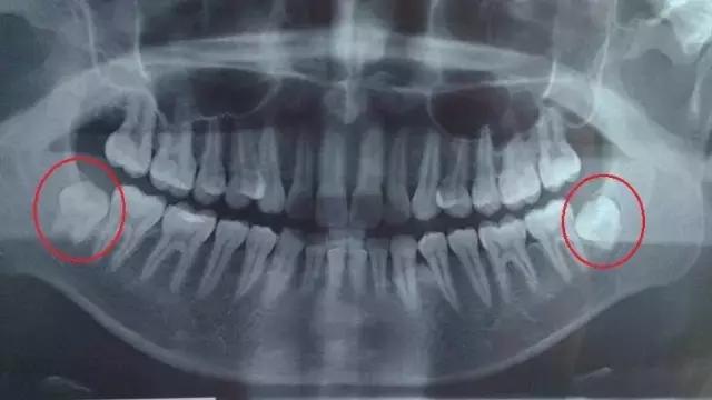智齿到底要不要拔掉专家告诉你,80%的人智齿都需要拔除