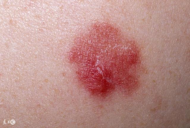 丘疹怎么调理饮食,丘疹的正确消除方法