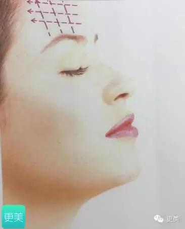 埋线美容线和不吸收线有什么区别,医院埋线和美容院埋线有什么差别