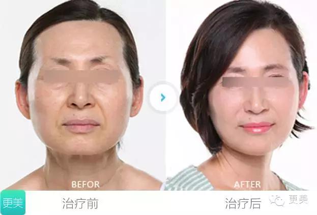 超声疑惑大揭秘,超声刀七大注意事项你都知道吗