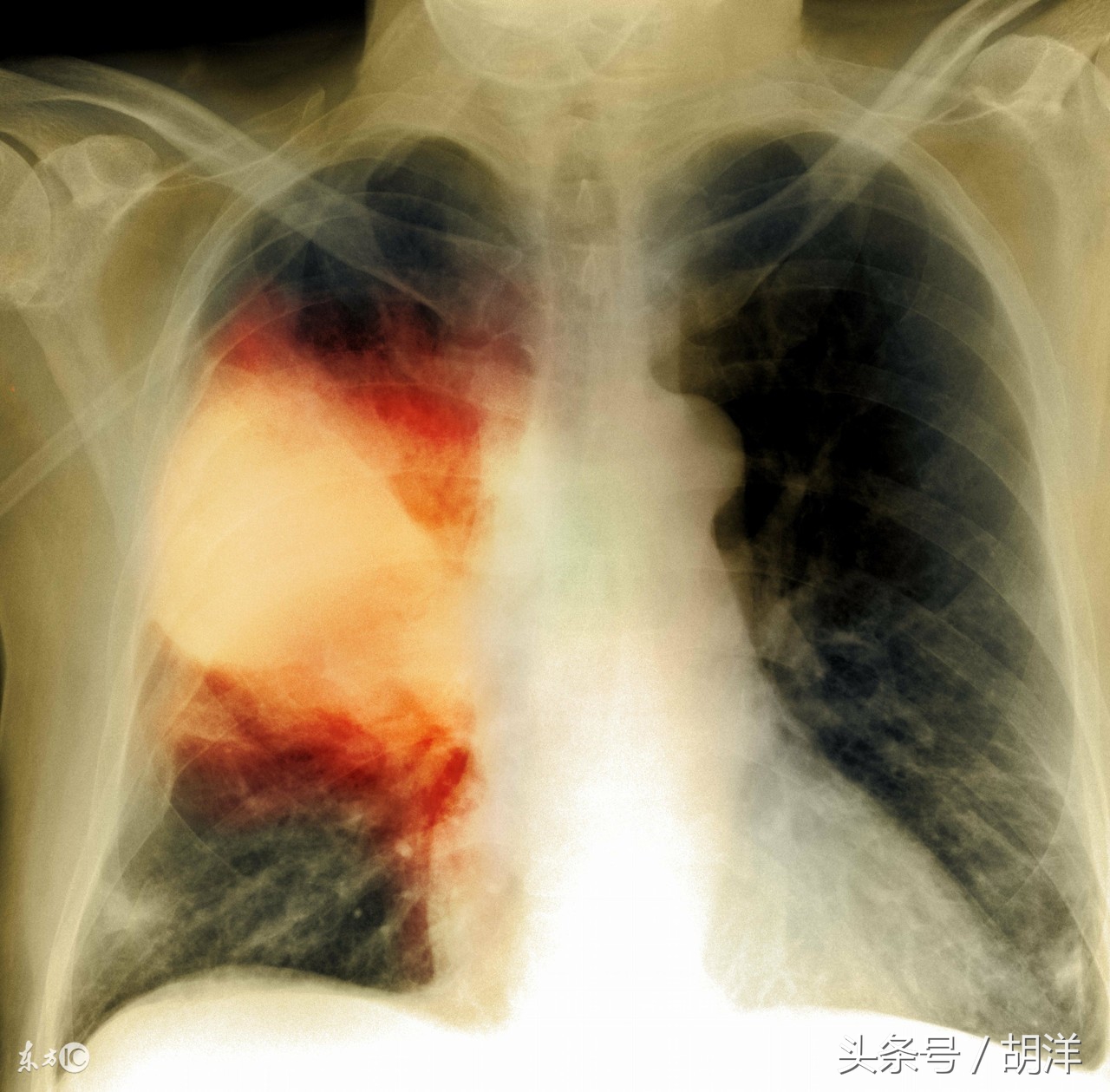 支气管扩张治愈后能喝酒吗,支气管扩张肺气肿能不能治愈