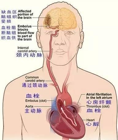 心脏抗凝期出血怎么办,心脏血肿手术