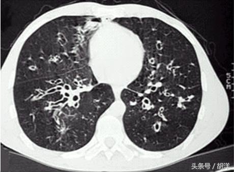 支气管扩张治愈后能喝酒吗,支气管扩张肺气肿能不能治愈