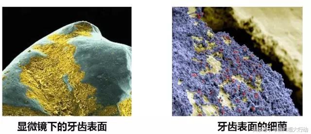 龋齿蛀牙有虫吗,科普蛀牙的形成