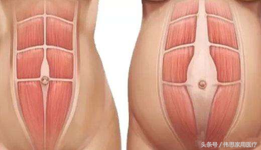 产后肚子什么时候能回去,产后肚子收不回去腹部突出