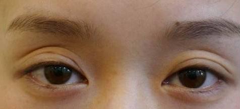 眼窝凹陷眼睛不舒服怎么办,眼窝凹陷要怎么才能好看