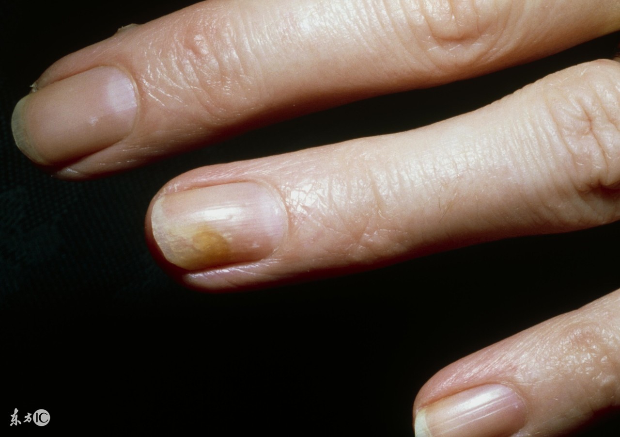 得了灰指甲不敢去医院,家人得了灰指甲我该怎么预防