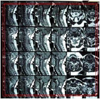 椎管内海绵状血管瘤都要手术吗？