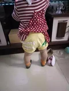 小孩子穿纸尿裤o型腿,穿纸尿裤会导致宝宝o型腿吗