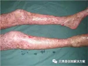 烧伤的治疗,烧伤的治疗土方