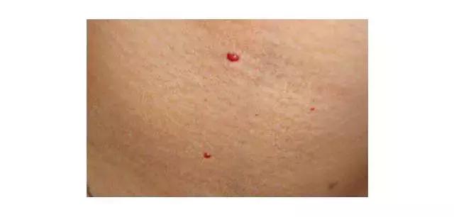 身上出的小红痣是什么原因造成的,身上出现小红痣是什么病症状