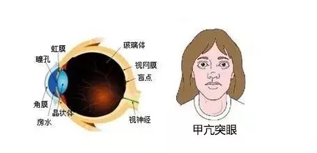 甲亢患者的眼部护理,甲亢病人护理诊断及护理措施