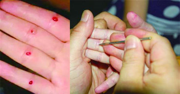 在手上扎针是不是可以治小孩挑食,小孩扎手指头治积食