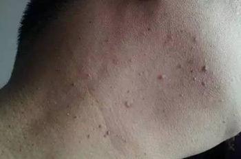 颈部长肉粒是什么病,颈部长好多小肉痣怎么治疗
