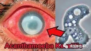 女孩戴隐形眼镜一个月未取失明,眼睛里取出来三十几片隐形眼镜