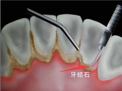 牙周炎中医治疗方法,牙齿牙周炎怎么治疗
