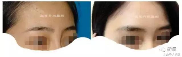 杨紫微整前后容颜对比,杨紫瘦了吗