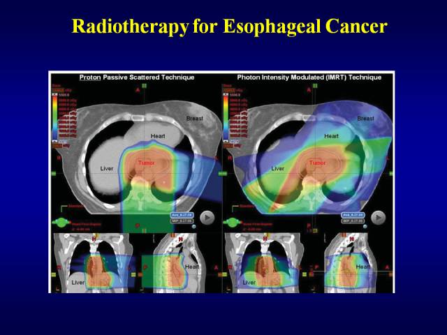 美国洛马林达质子治疗中心GaryYang：消化道肿瘤的质子放疗治疗