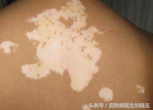 白癜风毛发变白治疗手段,白癜风是主流的治疗手段啥意思