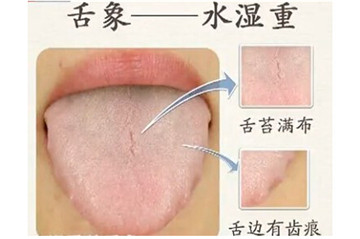 体检发现尿蛋白是怎么回事,出现尿蛋白的危害及治疗方法