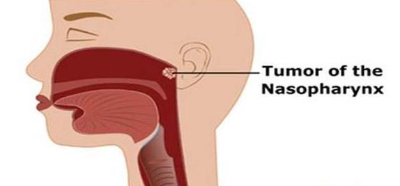 鼻咽癌的早期治愈率可达80以上,鼻咽癌患者最新明细