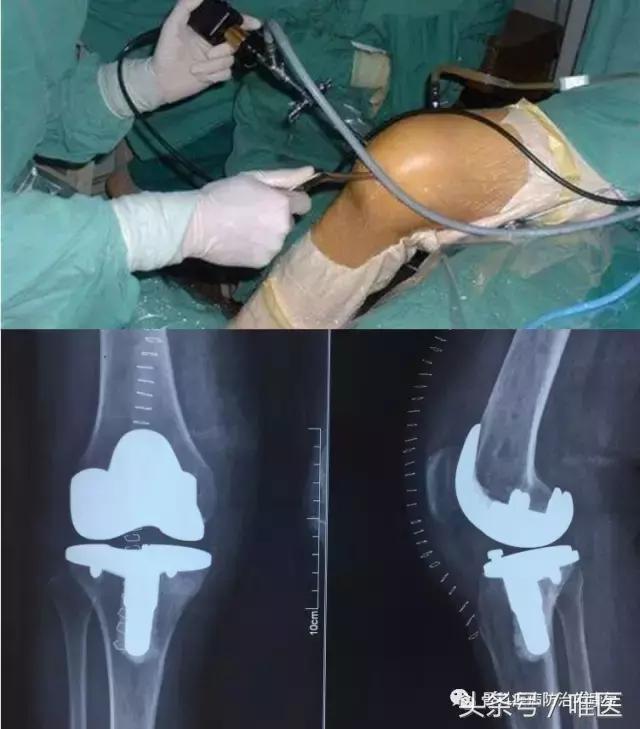 关于关节炎的疼痛肿胀是什么原因,关节炎滑膜炎疼痛难忍